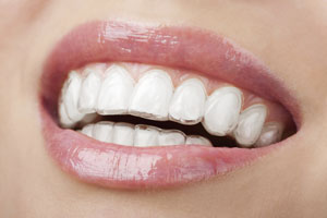 Closeup of teeth with Invisalign aligners in place